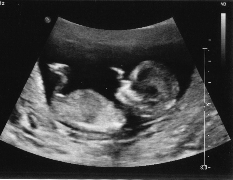12 ultrasound12weeks(1).jpg